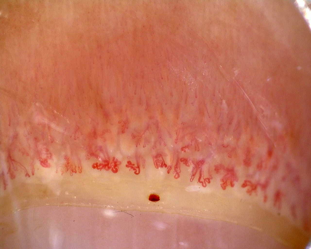 Preview image for Anti-Mi2β Dermatomyositis in Active Disease