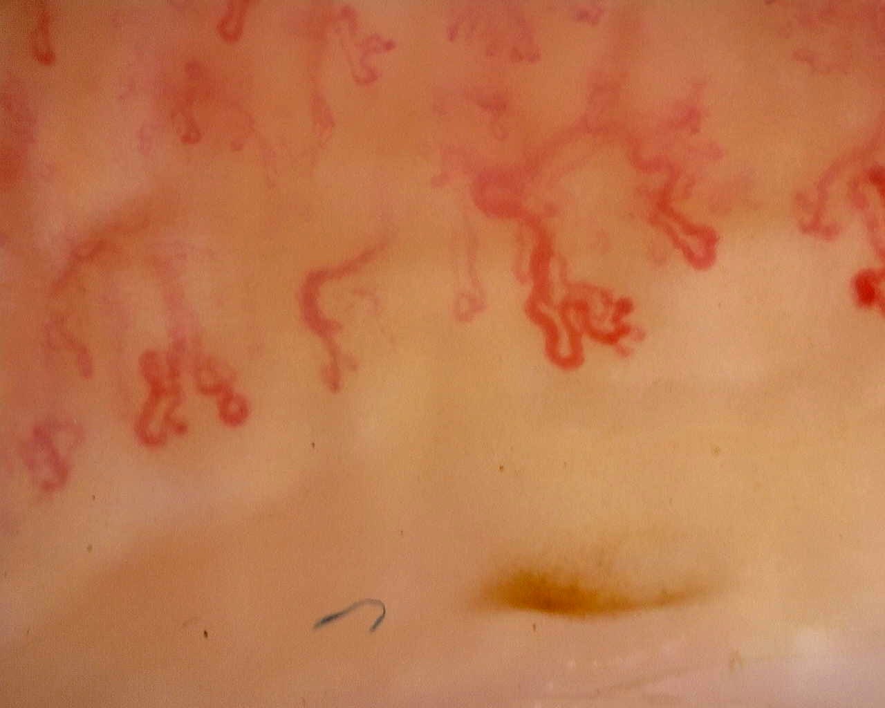 Preview image for Late SSc Cutolo Pattern: Representative Case