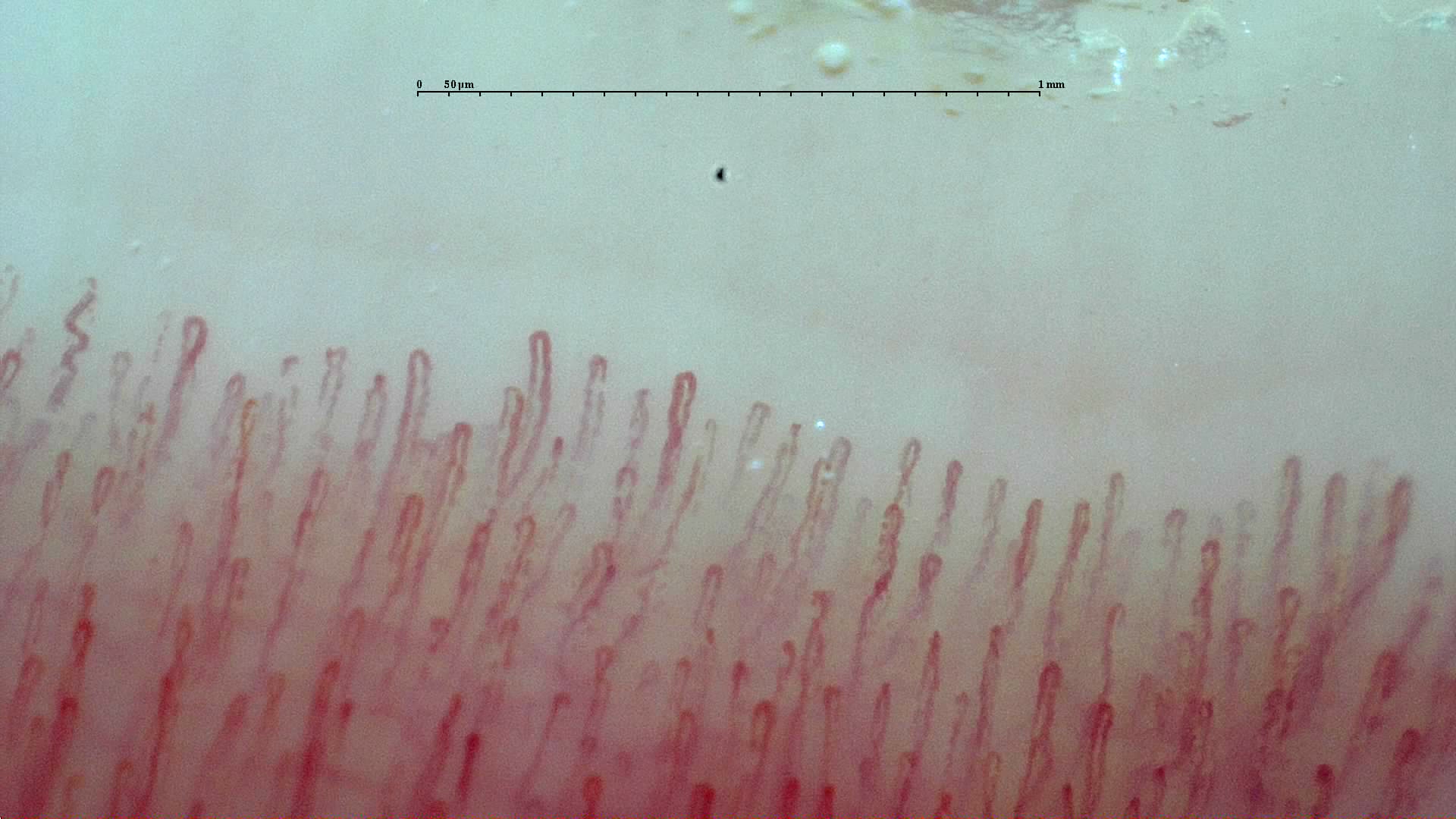 Normal nailfold capillaroscopy with orderly capillary loops.